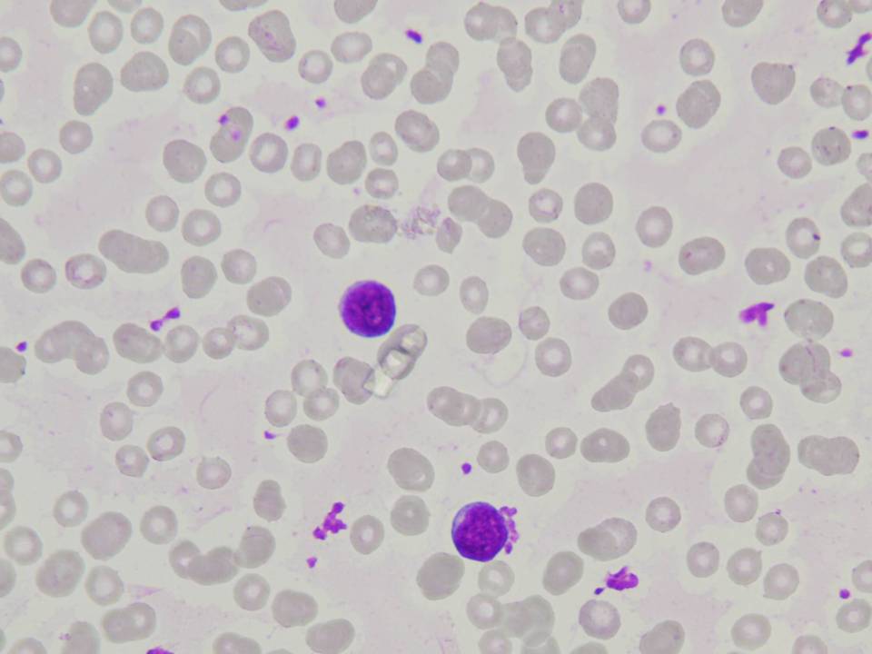 Peripheral blood, initial diagnosis